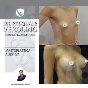 Foto intervento di mastoplastica additiva Dr. Pasquale Verolino