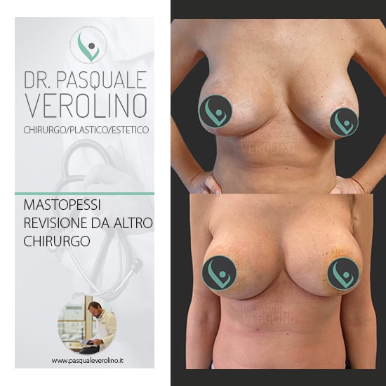 Mastopessi Napoli, Lifting del seno